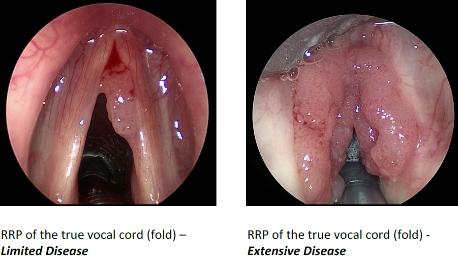 Laryngeal papilloma caused by Recurrent Respiratory Papillomatosis neuroendocrine cancer month